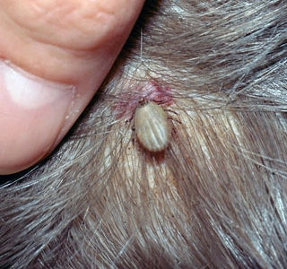 Found a Tick in Your Child's Hair? Here's What You Need to Know Now