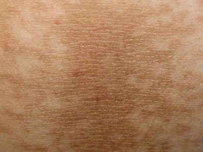 The Terrifying Truth: Your Skin Is Screaming Cancer Warnings Years Before You Know It