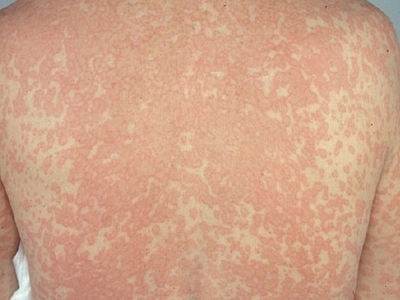 Doctors Called It An Allergy. 48 Hours Later, His Skin Was Falling Off In Sheets