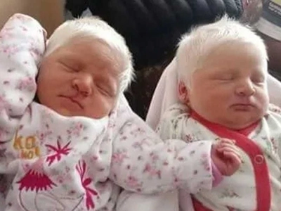 The First Albino Twins in Argentina: How Virginia and Catalina Redefine Beauty and Wonder