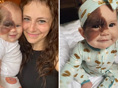 Mom Made It Mission to Show Daughter With Rare Birthmark Her ...