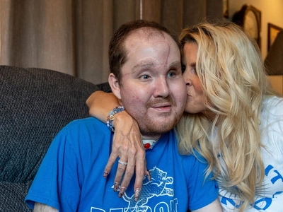 The Incredible 10-Year Journey That Led to This Miracle Face Transplant (You Won't Believe What Happened Next)