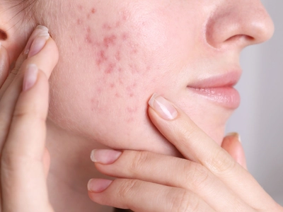CHEC | NHS Acne Treatment