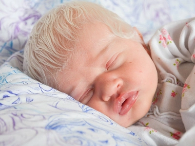 From Mocked Baby to Stunning Model: The Transformative Journey of Albinism