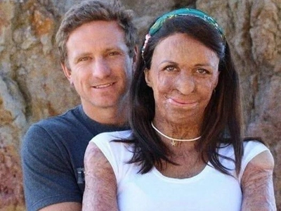 Unwavering Love After Fire: How One Husband Refused to Leave His Wife Despite Life-Altering Scars